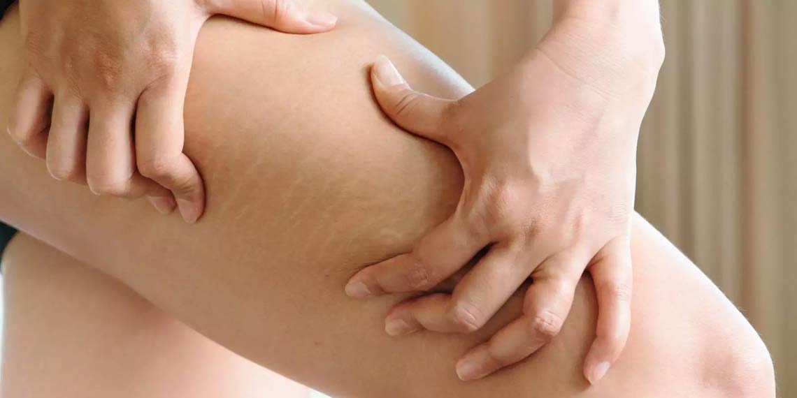 Herbal Remedies for Stretch Marks